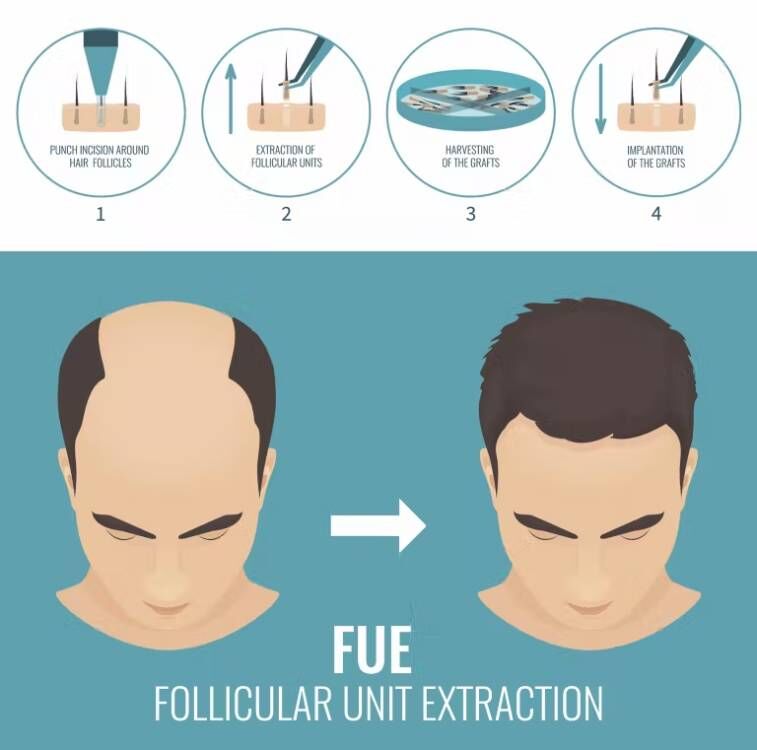 FUE saç Implant mikro Motor sa - Hair Care Basic incelemesi ve fiyatı